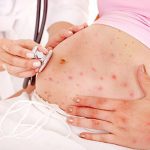 Bệnh rubella
