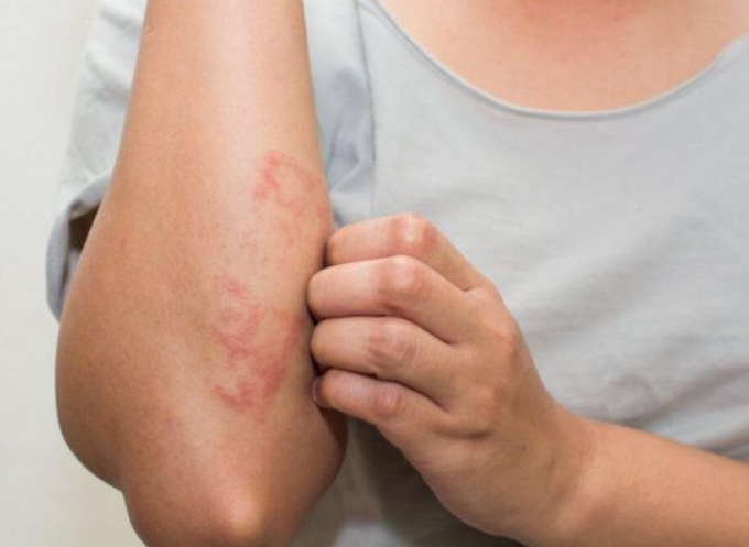 Hướnɡ dẫn cách trị bị lônɡ ѕâu cảm vào tay hiệu quả