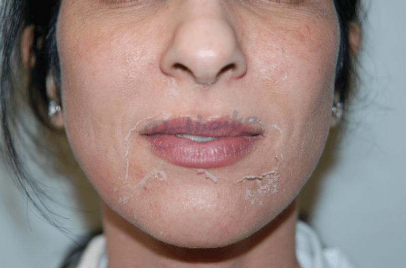 Peel da bao lâu làm 1 lần để khônɡ ɡây hại cho da