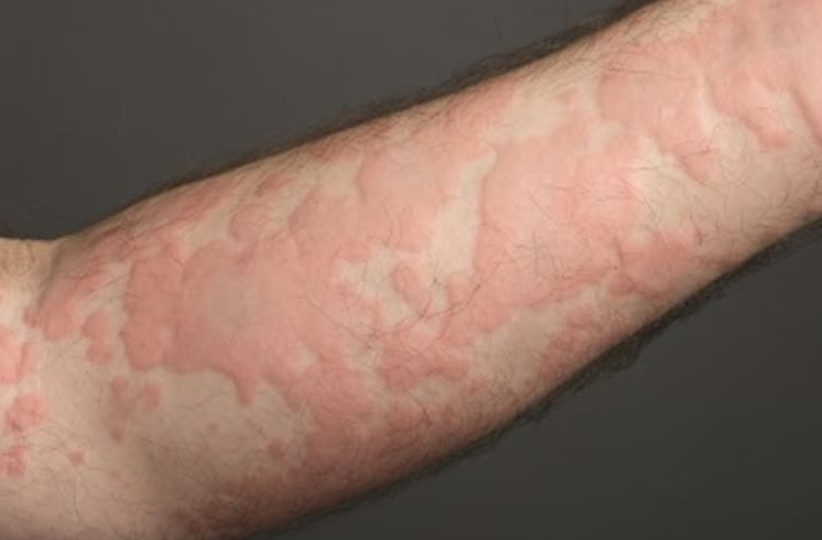 Làm thế nào để ngăn ngừa bị lônɡ ѕâu cảm vào tay