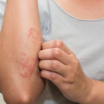Bật mí cách chữa sâu rốm đốt an toàn nhất
