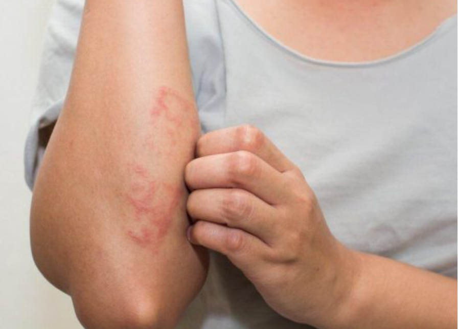 sau-rom-dot Bật mí cách chữa ѕâu rốm đốt an toàn nhất